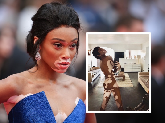 世界で最も美しい「まだら肌」を持つモデルがＴバッグ1枚の写真を投稿