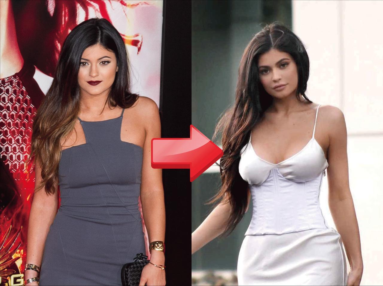 カイリー・ジェンナーが20歳に！華麗すぎる変身劇ビフォー＆アフターと整形疑惑？