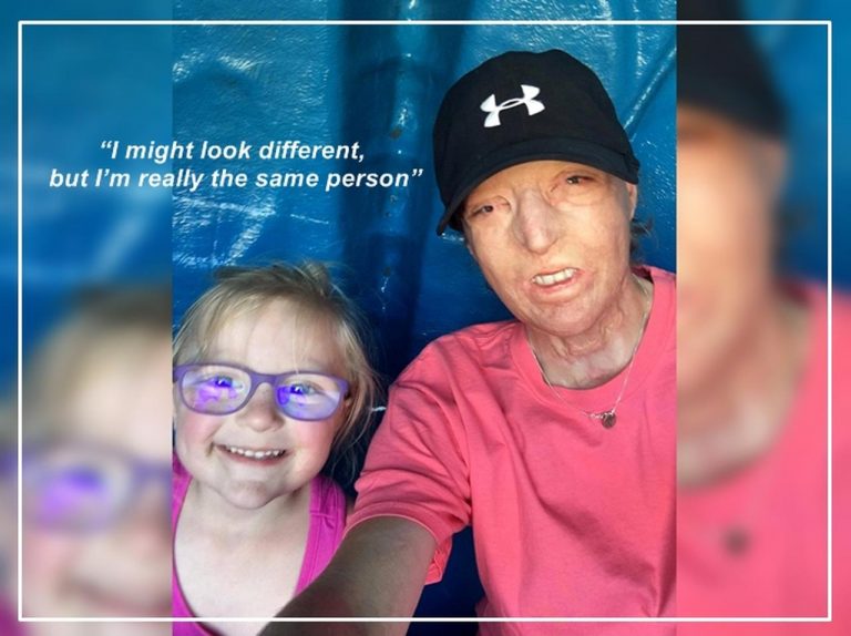 顔全体に重度のやけどを負った女性、5歳娘のある「行動」に救われる