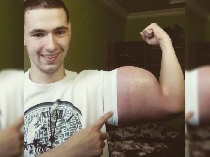 10日で上腕が巨大化…ロシア人男性が手を出した恐ろしすぎる方法