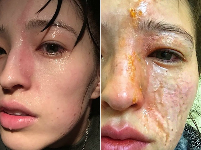 女性がエッセンシャルオイルのディフューザーで顔半分を火傷