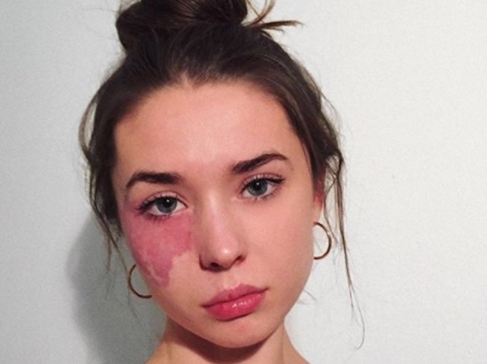 21歳女性の生まれつきの大きなシミが注目される理由