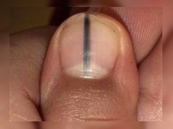 爪の「黒い縦線」に隠されたヒミツが恐ろしすぎる