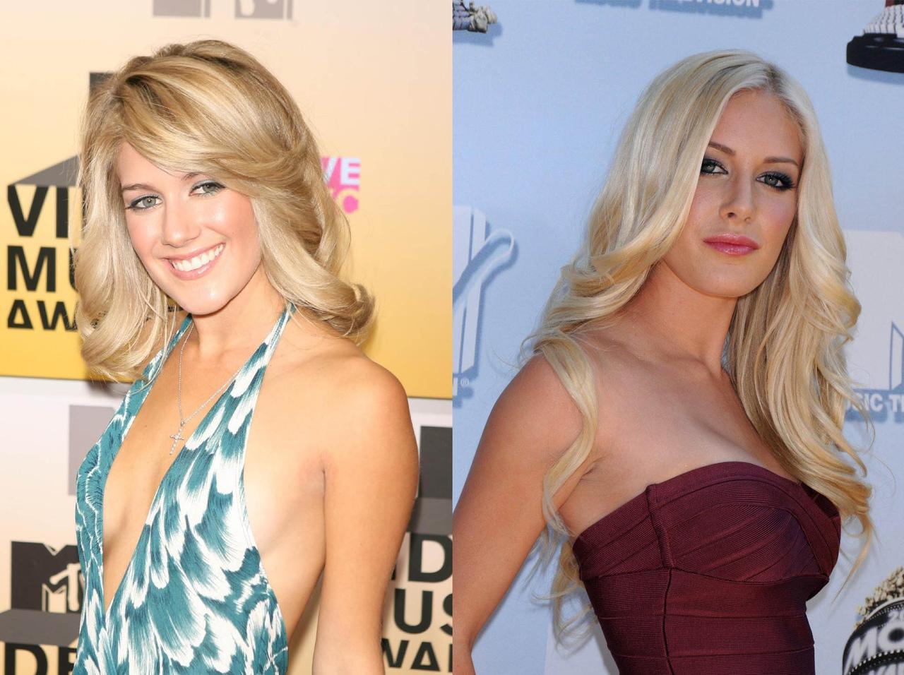 1度に10カ所の整形手術で「数分間死んだ」、人気セレブが語る整形の恐さ