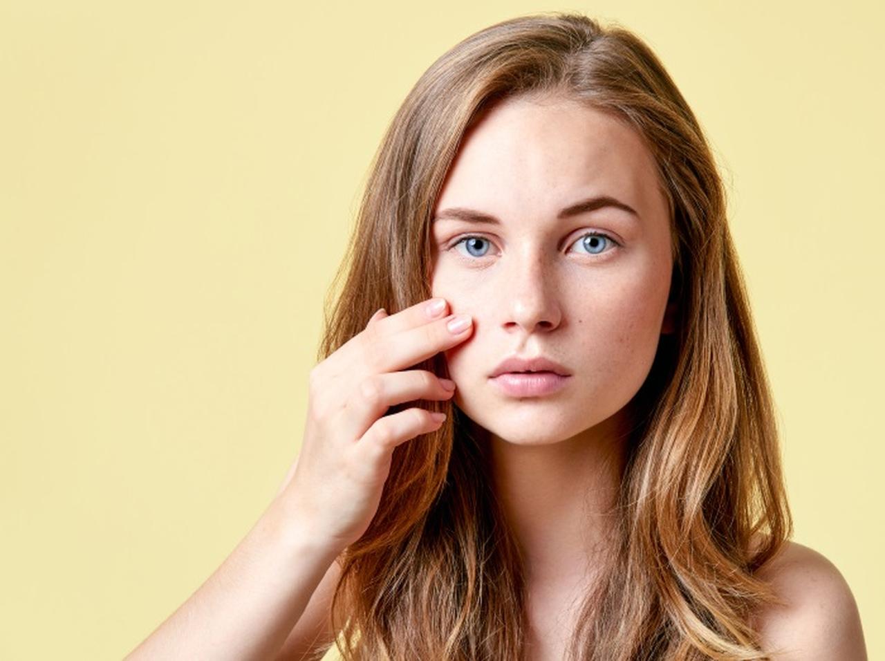 ニキビの場所で原因が分かる？専門医が教える「フェイスマップ」