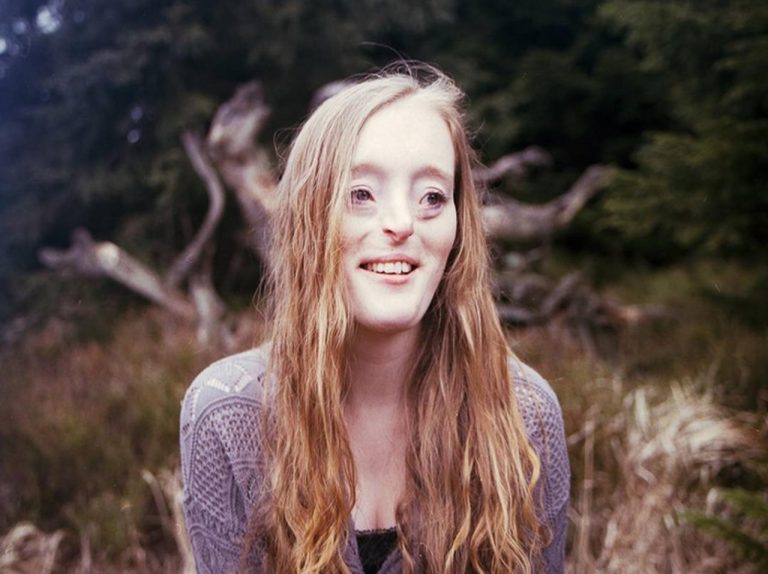 10回に及ぶ手術やいじめを乗り越えた女性、「すべての人は美しい」と語る