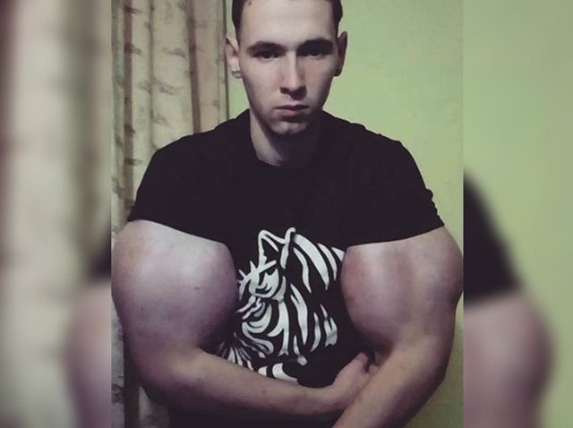 オイル注射で腕が「リアルポパイ化」した男性、次はキャットフードで巨大化に挑戦