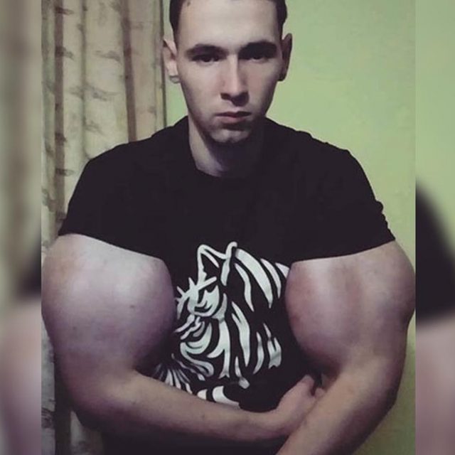 オイル注射で腕が「リアルポパイ化」した男性、次はキャットフードで巨大化に挑戦
