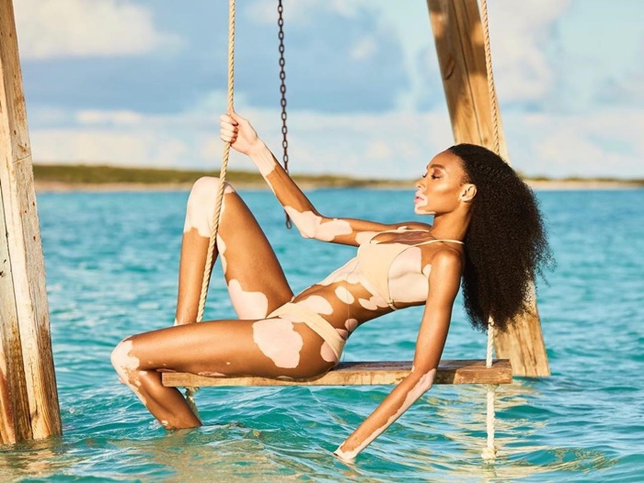 まだら肌のウィニー・ハーロウが人気水着雑誌で「史上初」を達成