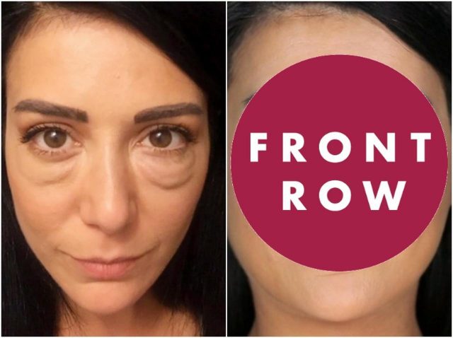 涙袋の整形失敗で人生がメチャクチャに…20人の医師に手術断られた女性が笑顔を取り戻す