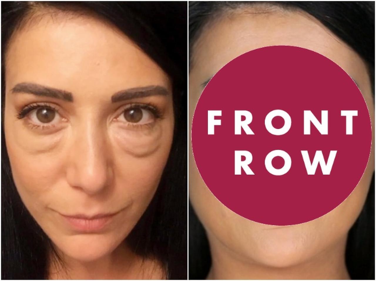 涙袋の整形失敗で人生がメチャクチャに…20人の医師に手術断られた女性が笑顔を取り戻す