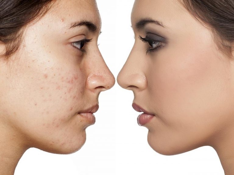 ニキビを自然に隠すメイクテクが目からウロコ!カギは意外なアイテム