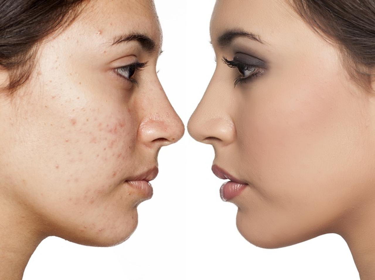 ニキビを自然に隠すメイクテクが目からウロコ！カギは意外なアイテム