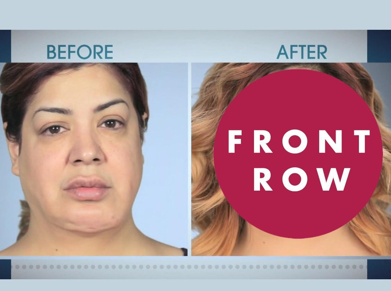 整形失敗して悪夢見た女性、「フェイスリフト」と「切らないタルミ治療」でハート型小顔に