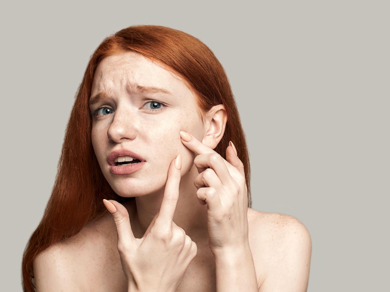 ひと晩でニキビを治したい！1日でも早く治すケア方法3つ