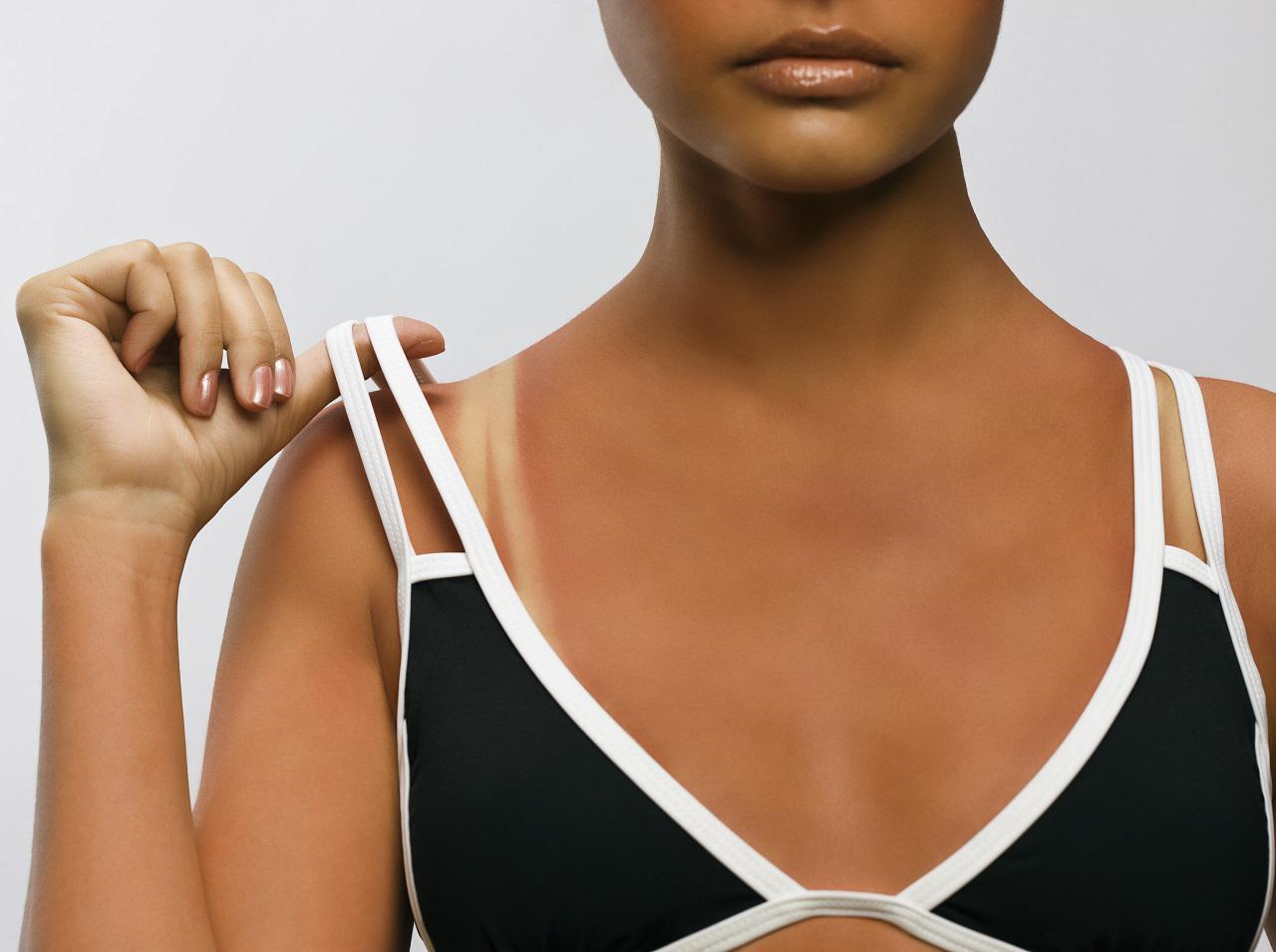 体の「日焼け跡」を薄くしたい！焼けてしまった後にやるべきボディケア