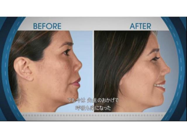 10回の整鼻術の再形成、ヒアルロン酸注射で壊死…『ボッチド：整形手術の光と闇』シーズン6後半は衝撃の症例が次々