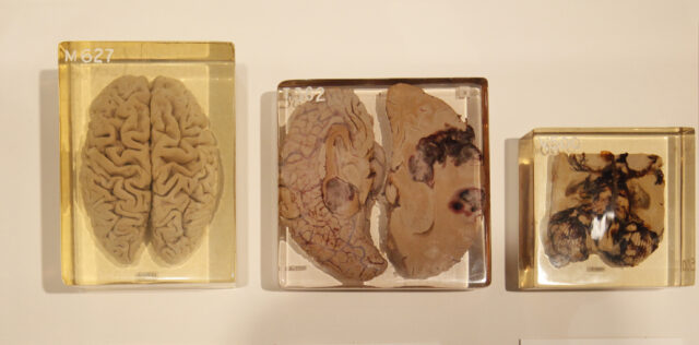 脳の老化の7割は「腸」で決まる？専門家が明かすNG習慣5つ